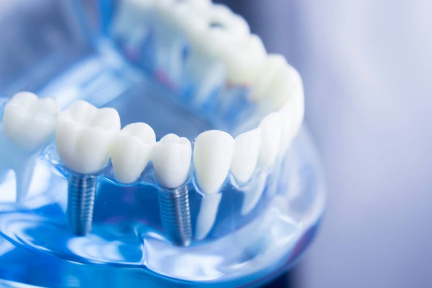 Czy implanty dentystyczne są zdrowe i bezpieczne?